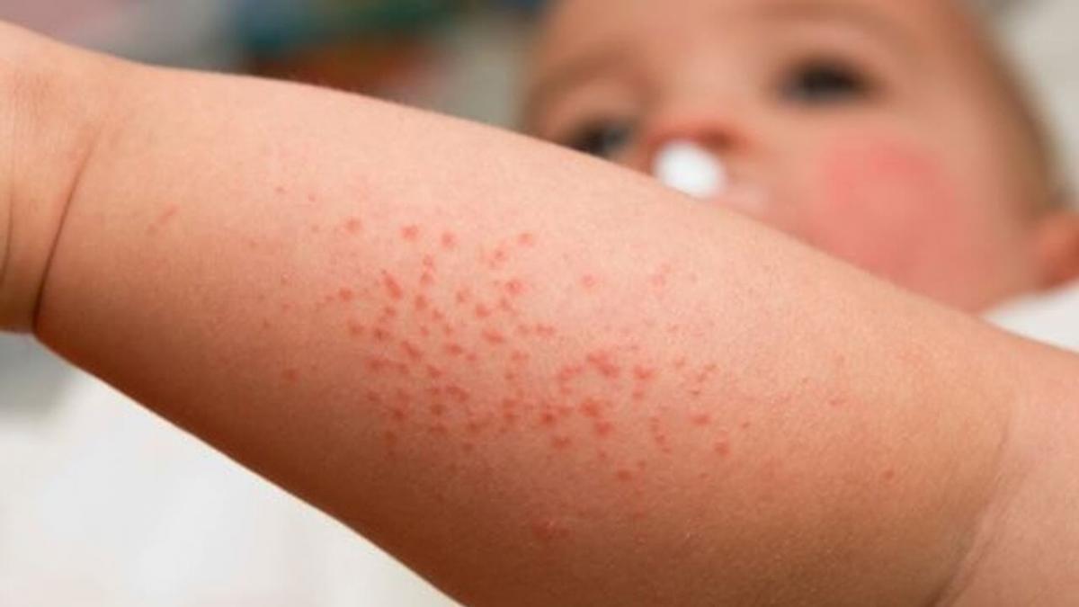 نکات ایمنی و اقدامات اولیه پس از گزیدگی حشرات